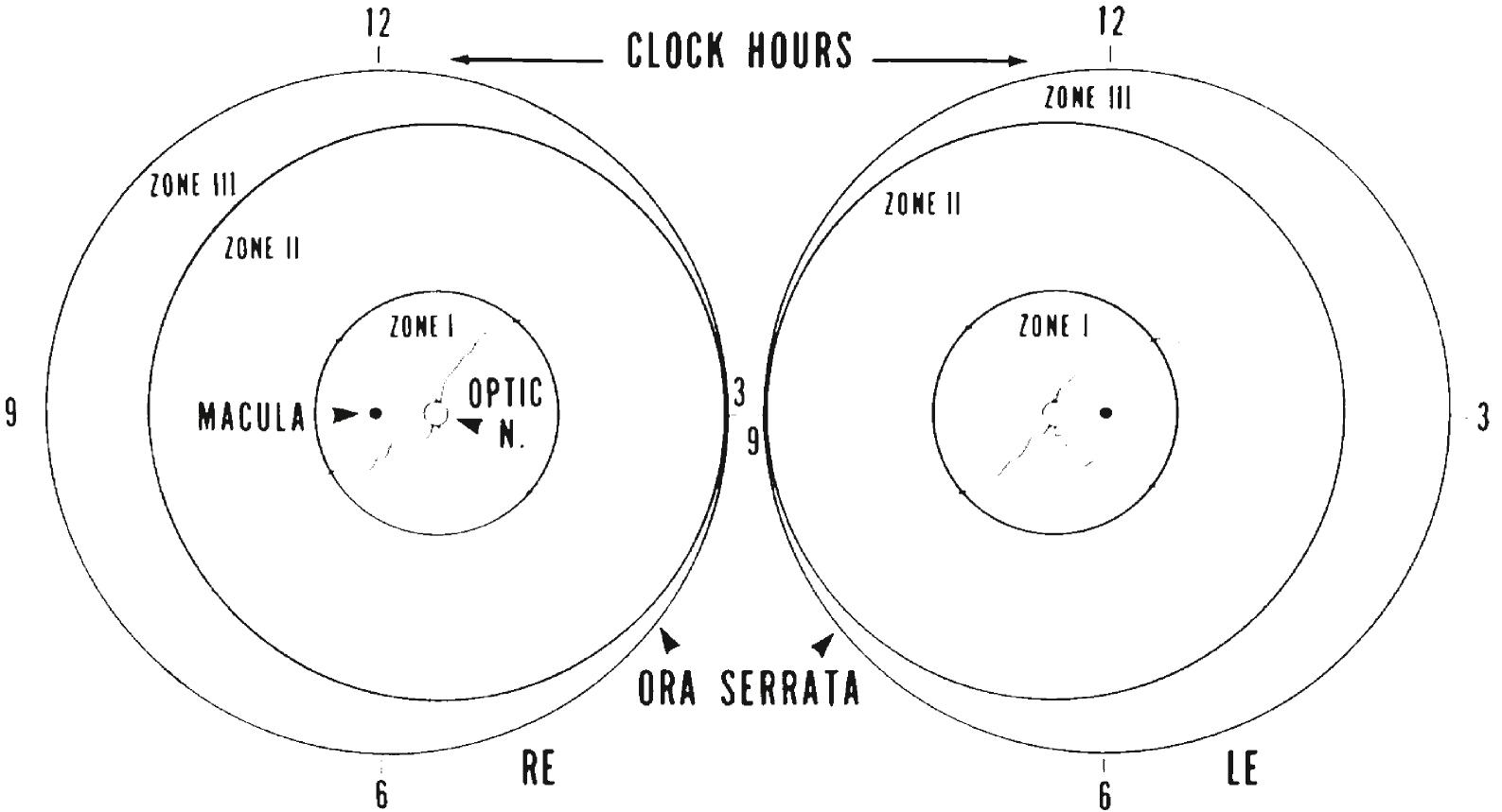 Fig. 43.10, The international classification of retinopathy of prematurity (ROP). The stage of ROP is determined by the location, extent, and stage of disease according to the position of the advancing waves of retinal vessels. LE, left eye; RE, right eye.