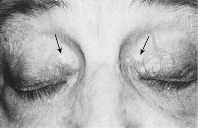 Figure 45.14, Xanthelasma of upper eyelids in a patient who had no systemic findings (arrows) .