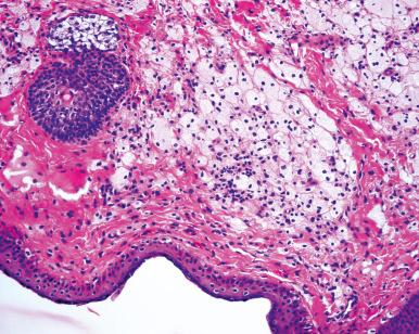 Figure 45.15, Xanthelasma of Eyelid.