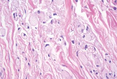 Figure 45.16, Bland histiocytoid metastatic lobular breast carcinoma involving eyelid and orbit.