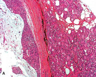 Figure 45.17, Benign mixed tumor of lacrimal gland largely composed of so-called hyaline cells: A , low-power view showing encapsulated quality; B , high-power view showing a diffuse eosinophilic appearance of the cytoplasm; C , strong immunoreactivity for S-100 protein.