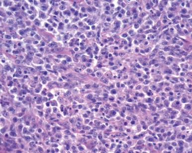 Figure 45.18, Diffuse large B cell lymphoma involving lacrimal gland and orbit.