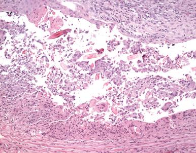 Figure 45.2, Ruptured orbital dermoid cyst containing hair with foreign body reaction.