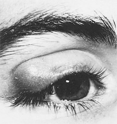 Figure 45.4, Chalazion of right upper eyelid.