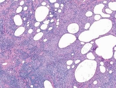 Figure 45.5, Multiple foci of granulomatous inflammation with lipid drop-out spaces in chalazion.