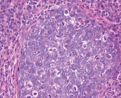 Figure 45.8, Poorly differentiated sebaceous carcinoma.