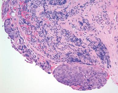 Figure 45.9, Sebaceous carcinoma replacing the majority of the conjunctival epithelium.