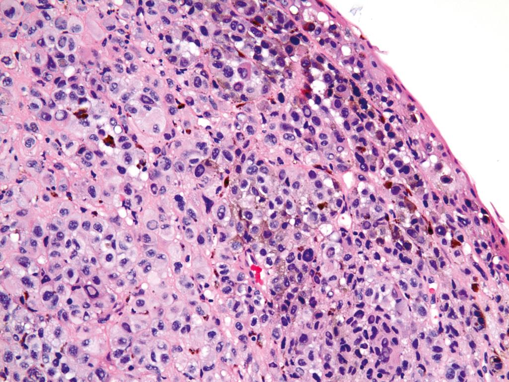 Figure 20.1, Conjunctival melanoma.