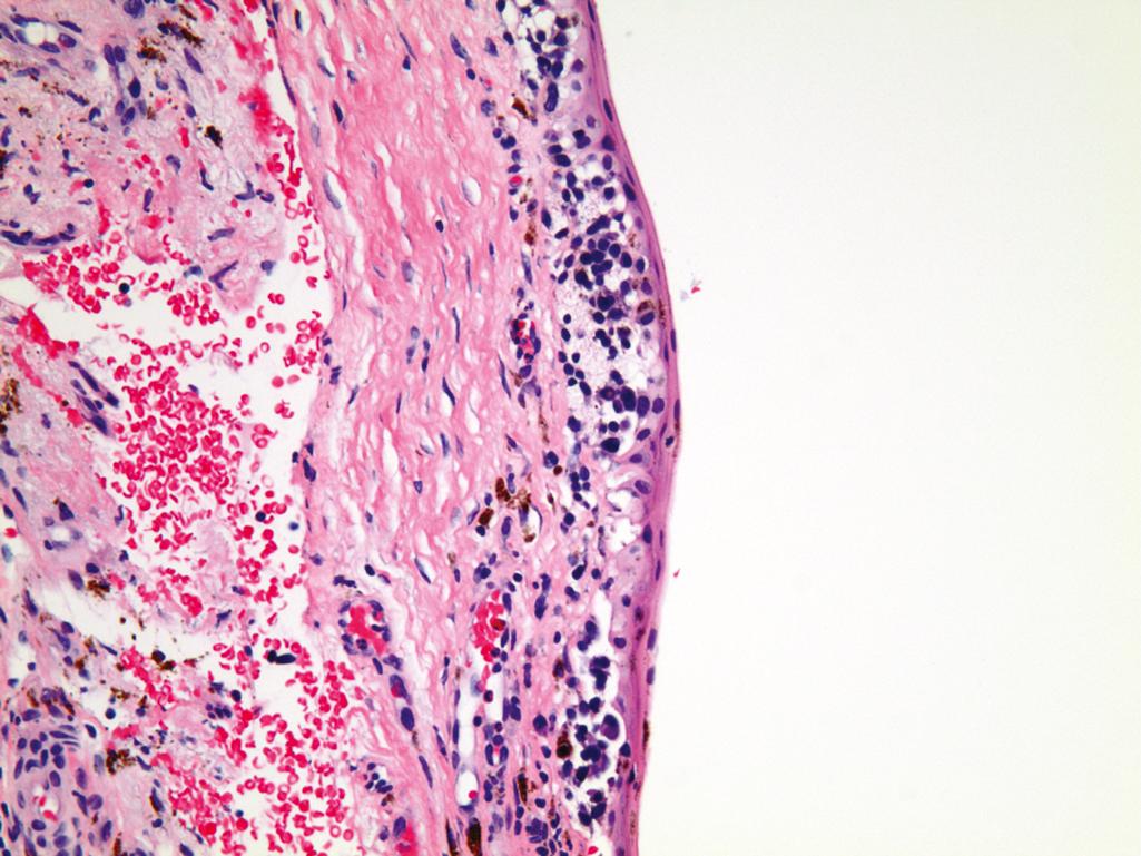 Figure 20.2, Primary acquired melanosis of the conjunctiva.