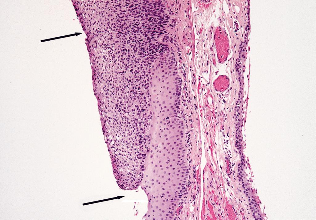 Figure 20.4, Squamous carcinoma.