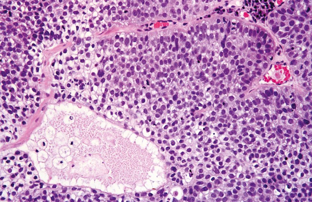 Figure 20.5, Sebaceous carcinoma with typical comedo pattern.