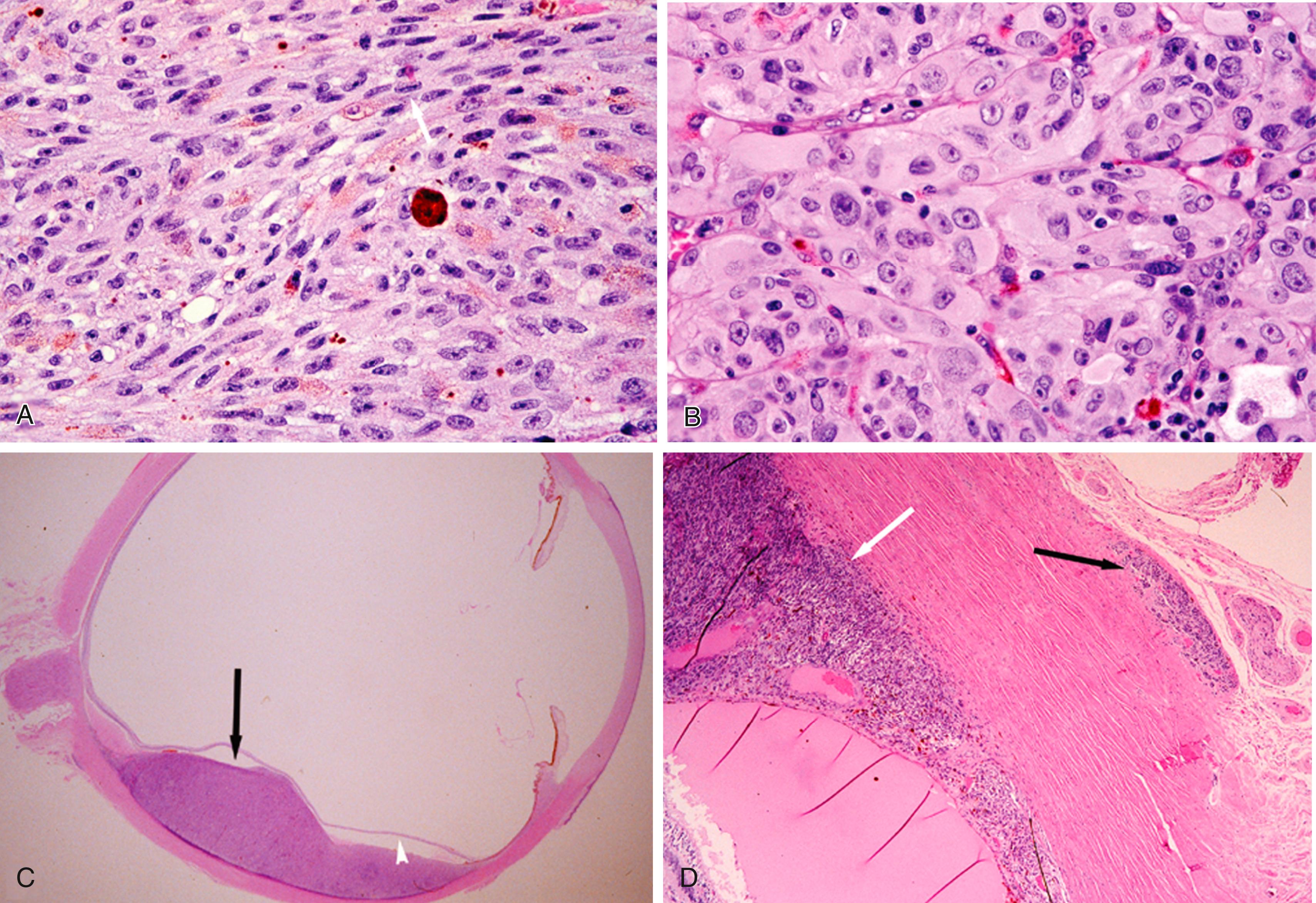 Figure 20.6, A, Typical spindle B choroidal melanoma. The white arrow indicates a spindle A cell, whereas most of the cells are of the spindle B variety. B, Epithelioid melanoma. Large flat cells with prominent nucleoli and marked pleomorphism. This histopathologic appearance is an ominous prognosticator. C, Cross section of whole globe with choroidal melanoma. Arrow indicates a dome-shaped mass under the retina (arrowhead) . D, Choroidal melanoma with extraocular extension. Choroidal tumor is indicated by the white arrow, extraocular tumor by the black arrow.