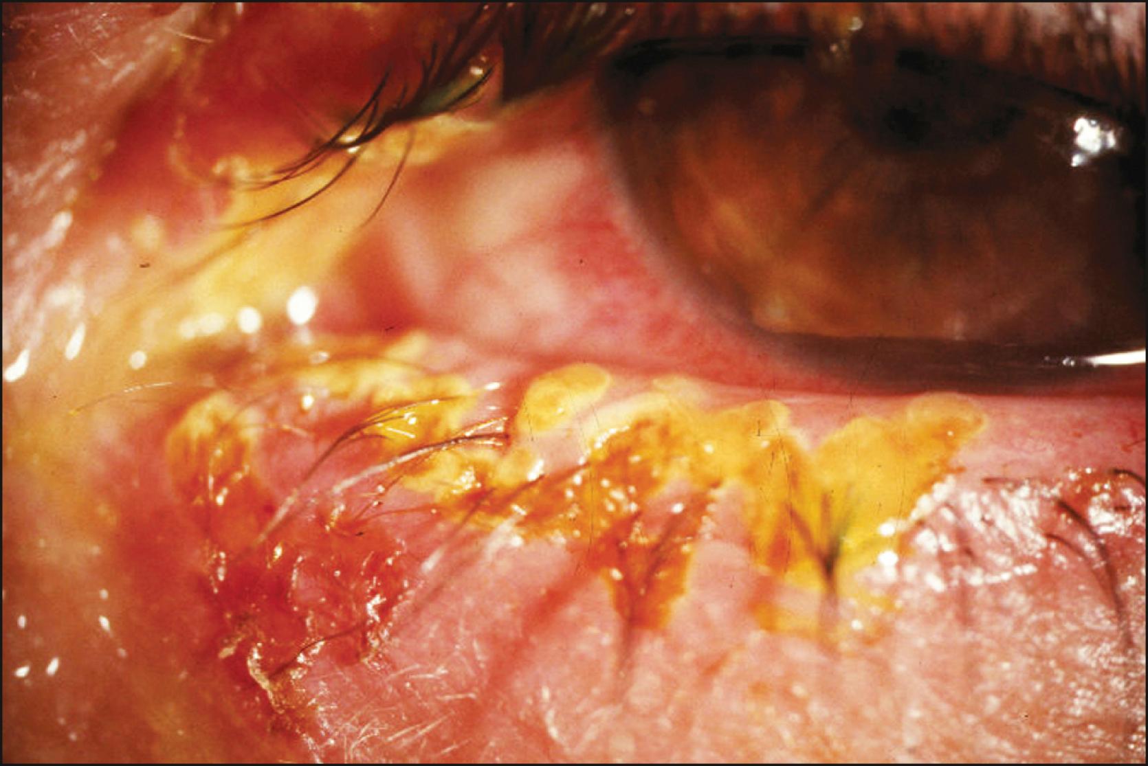 Fig. 30.1, Ulcerative herpes simplex blepharitis.