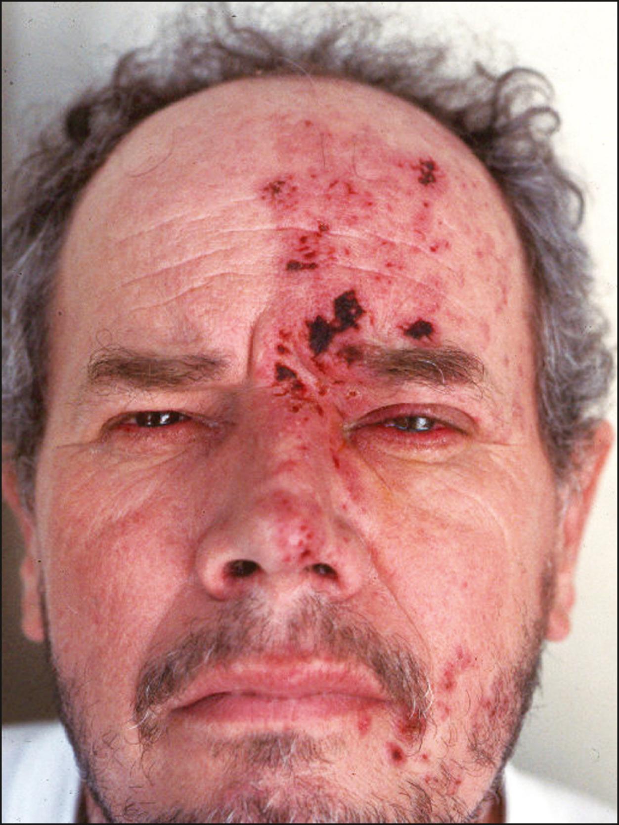 Fig. 30.2, Herpes zoster skin eruption with the classical involvement of the tip of the nose (Hutchinson sign).