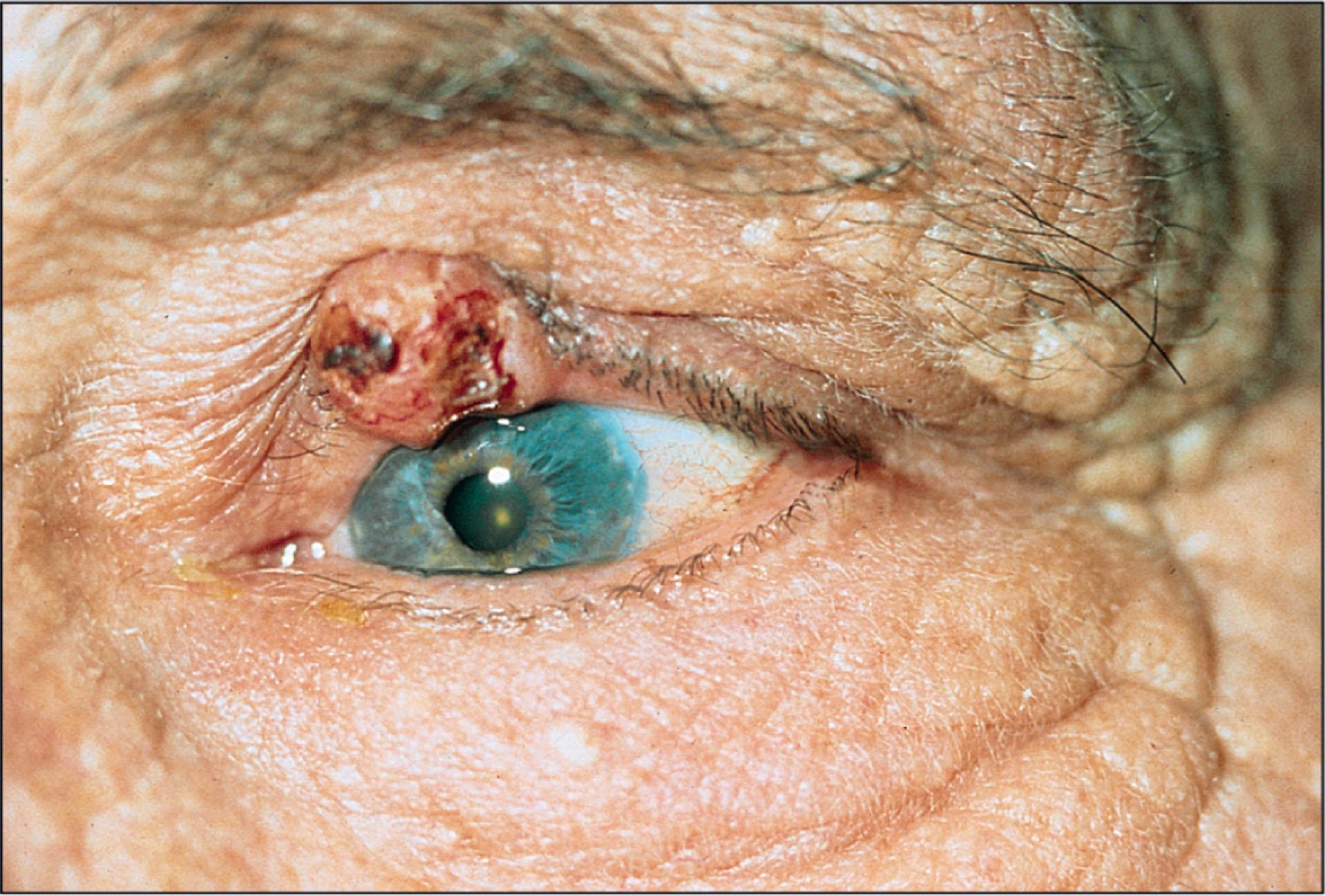 Fig. 12.8.1, Nodular Basal Cell Carcinoma (BCC) of the Eyelid.