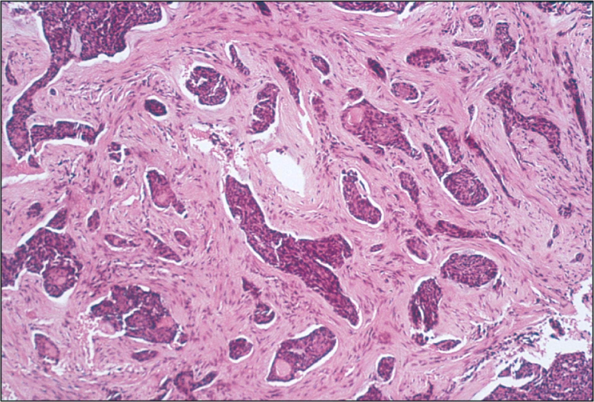 Fig. 12.8.3, Morphea or Sclerosing Type of Basal Cell Carcinoma of the Eyelid.