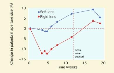 Fig. 6.2, Changes in palpebral aperture size (%) over 13 weeks of extended wear of a rigid lens in one eye and a soft lens in the other eye and 7 weeks of recovery.