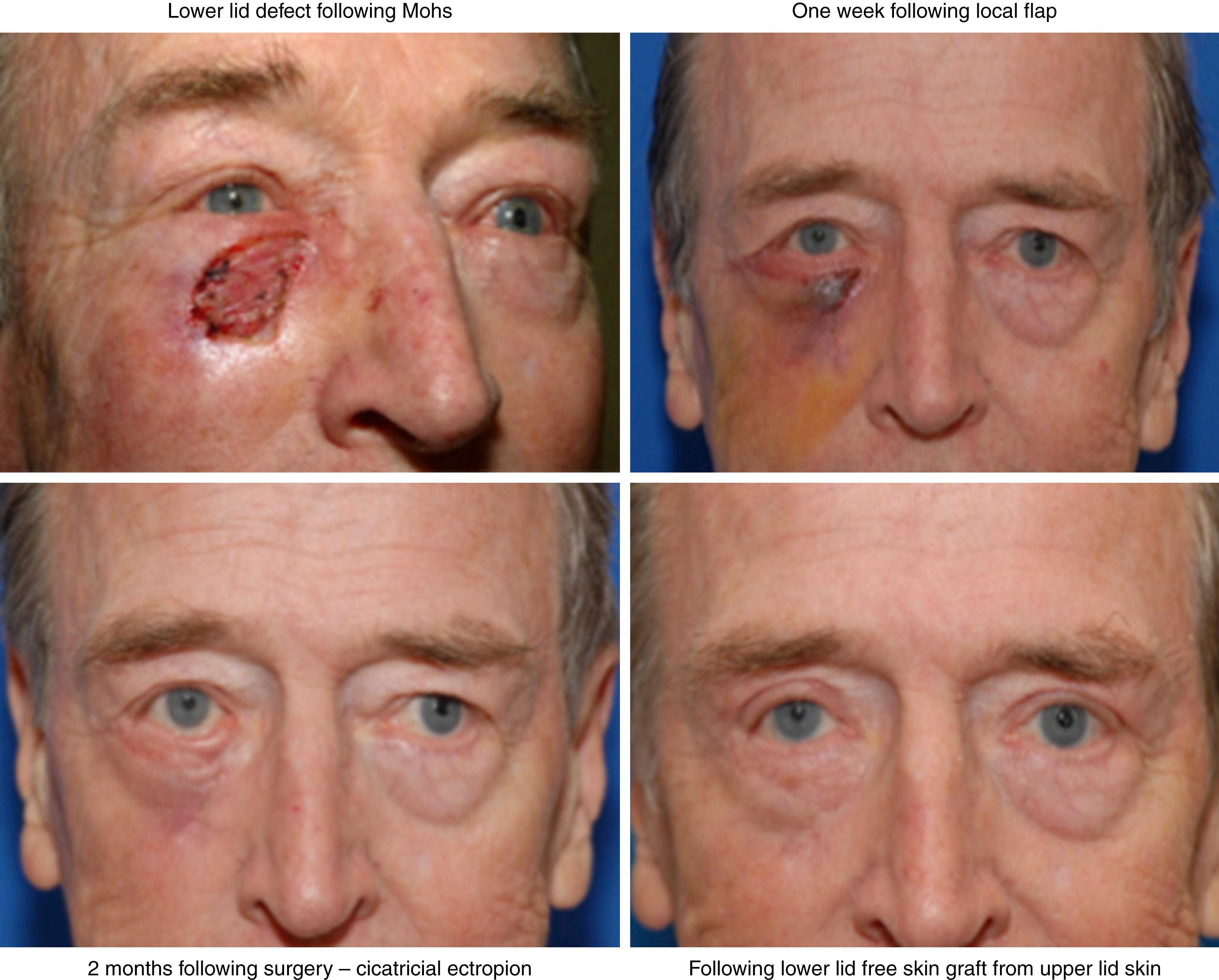 Fig. 31.4, Staged approach to lower eyelid reconstruction. First, the lower eyelid defect is closed with a local advancement flap. Two months later, cicatricial ectropion is noted, which is sometimes unavoidable in older individuals with lower eyelid laxity. This is repaired with a free skin graft from the upper eyelid, paired with a contralateral blepharoplasty for optimal cosmesis.