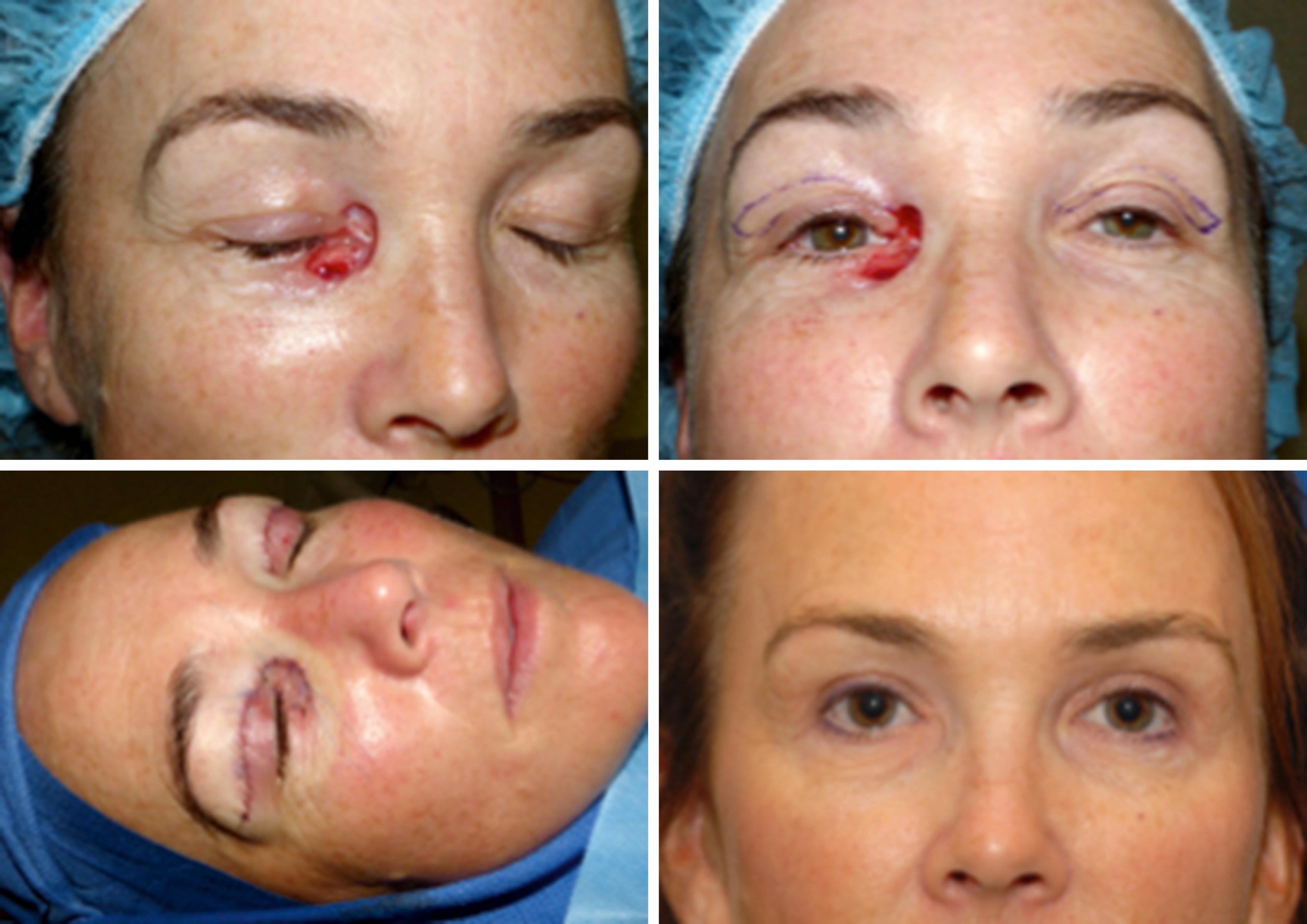 Fig. 31.5, Free skin graft from the ipsilateral upper eyelid was used to reconstruct a medial canthal defect. This was paired with a contralateral blepharoplasty for optimal esthetic result.