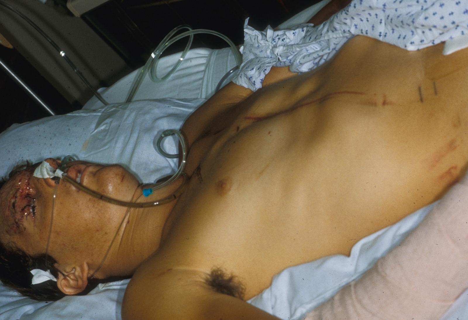 Figure 13.1, Cardiac contusion caused by the seat belt following a motor vehicle accident. The patient’s other injuries included a severe eyelid laceration.