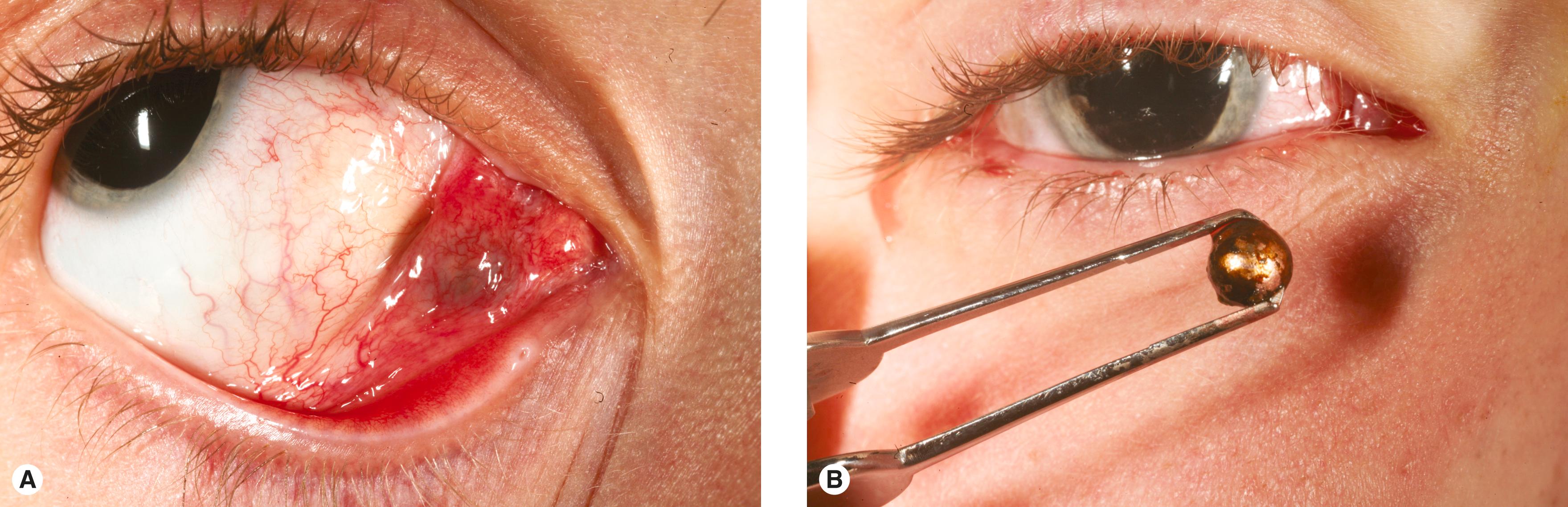 Figure 13.3, ( A ) Unusual conjunctival swelling in a 12-year-old boy with “no history” of trauma. ( B ) BB removed from conjunctiva. The boy later disclosed that he and a friend were playing with BB guns!