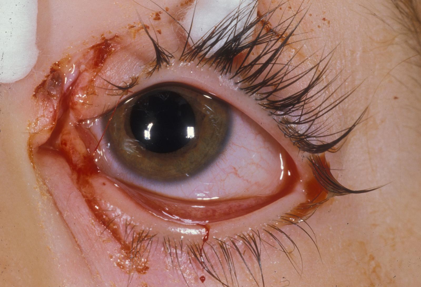 Figure 13.5, Canalicular lacerations of upper and lower eyelids.