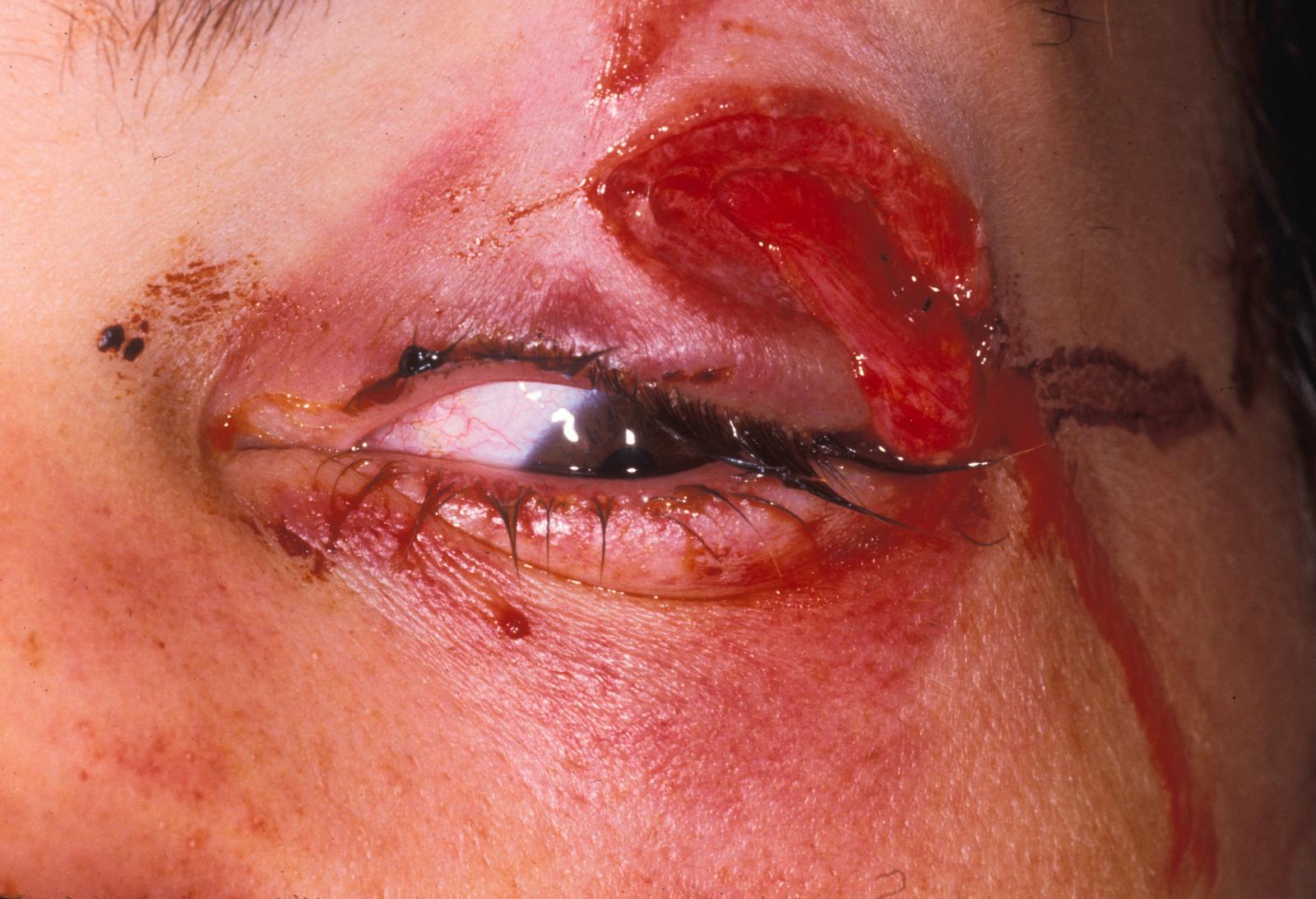 Figure 13.7, Any visible orbital fat means that the septum has been violated. Rule out injury to the eye, orbit, or brain and the possibility of the presence of a foreign body.