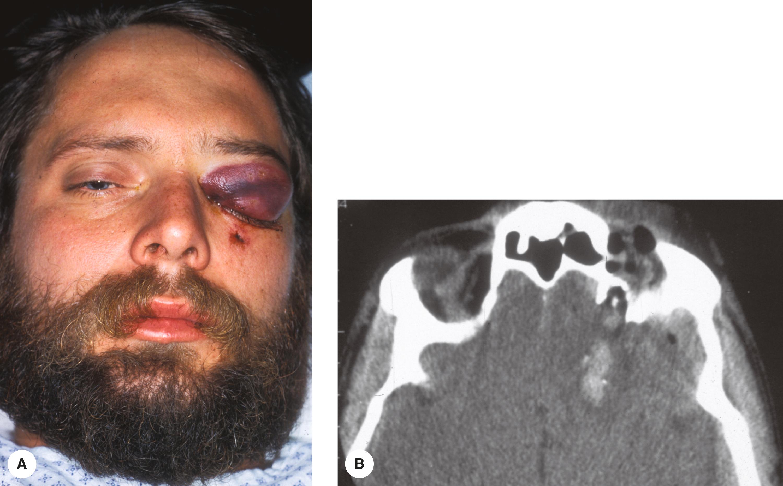 Figure 13.8, Deep orbital penetration through a small skin wound at the inferior orbital rim. ( A ) The patient had a small laceration and ecchymosis after falling on a tree branch. ( B ) Total ophthalmoplegia and no light perception vision were noted as a result of penetration of the branch through the orbit and into the brain.