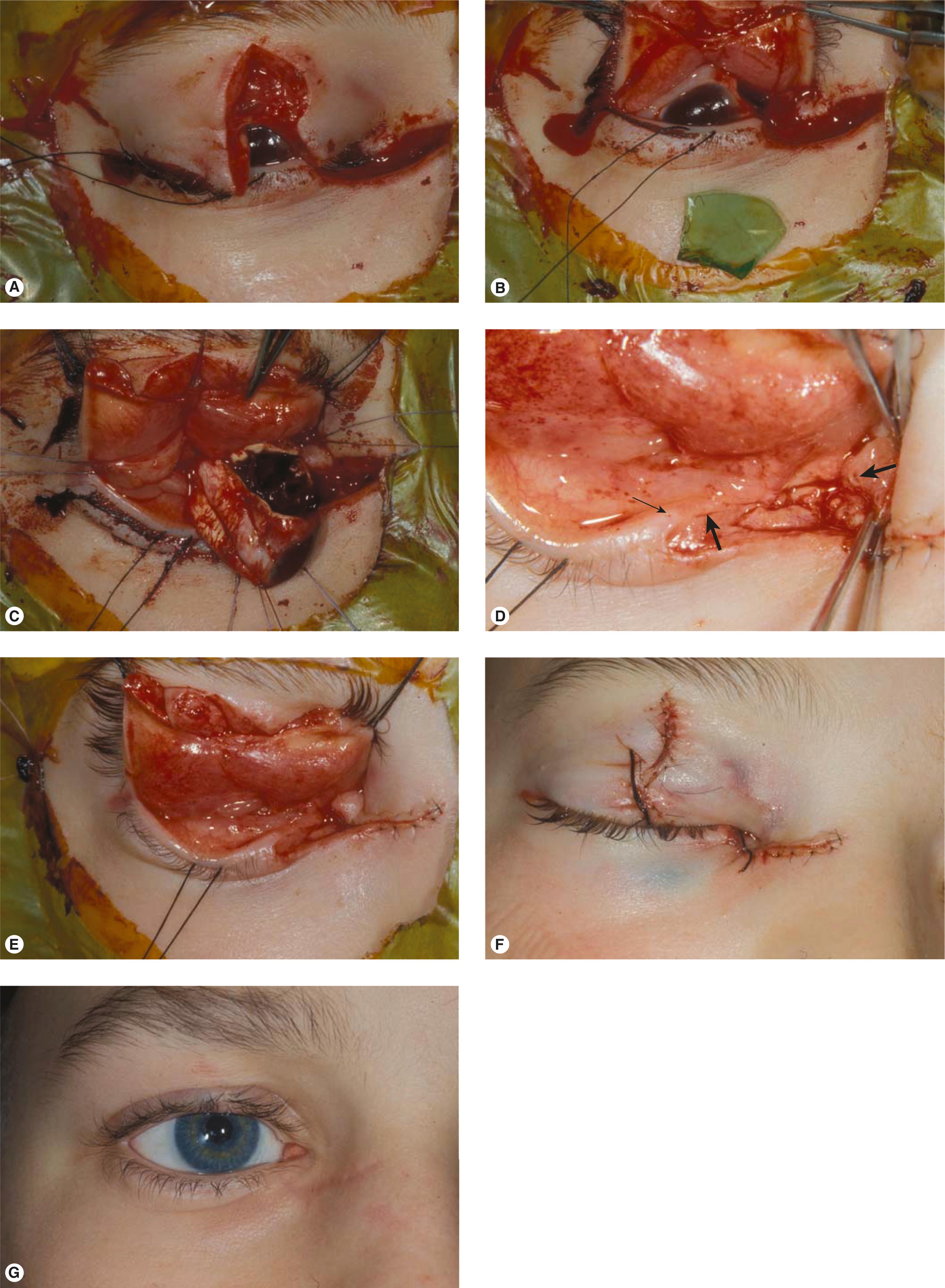 Figure 13.9, Eyelid laceration resulting from an explosion of a bottle containing dry ice. Complex laceration repair series. ( A ) Upper eyelid and medial canthal lacerations. The eye is soft and filled with blood. ( B ) A large piece of glass penetrated the cornea. ( C ) Primary enucleation was performed. ( D ) A canalicular laceration was identified and repaired ( small arrow points to punctum; large arrows point to cut ends of canaliculus). ( E ) The posterior lamella and eyelid were repaired. ( F ) The anterior lamella was repaired last. ( G ) Nine months after repair with ocular prosthesis in place.