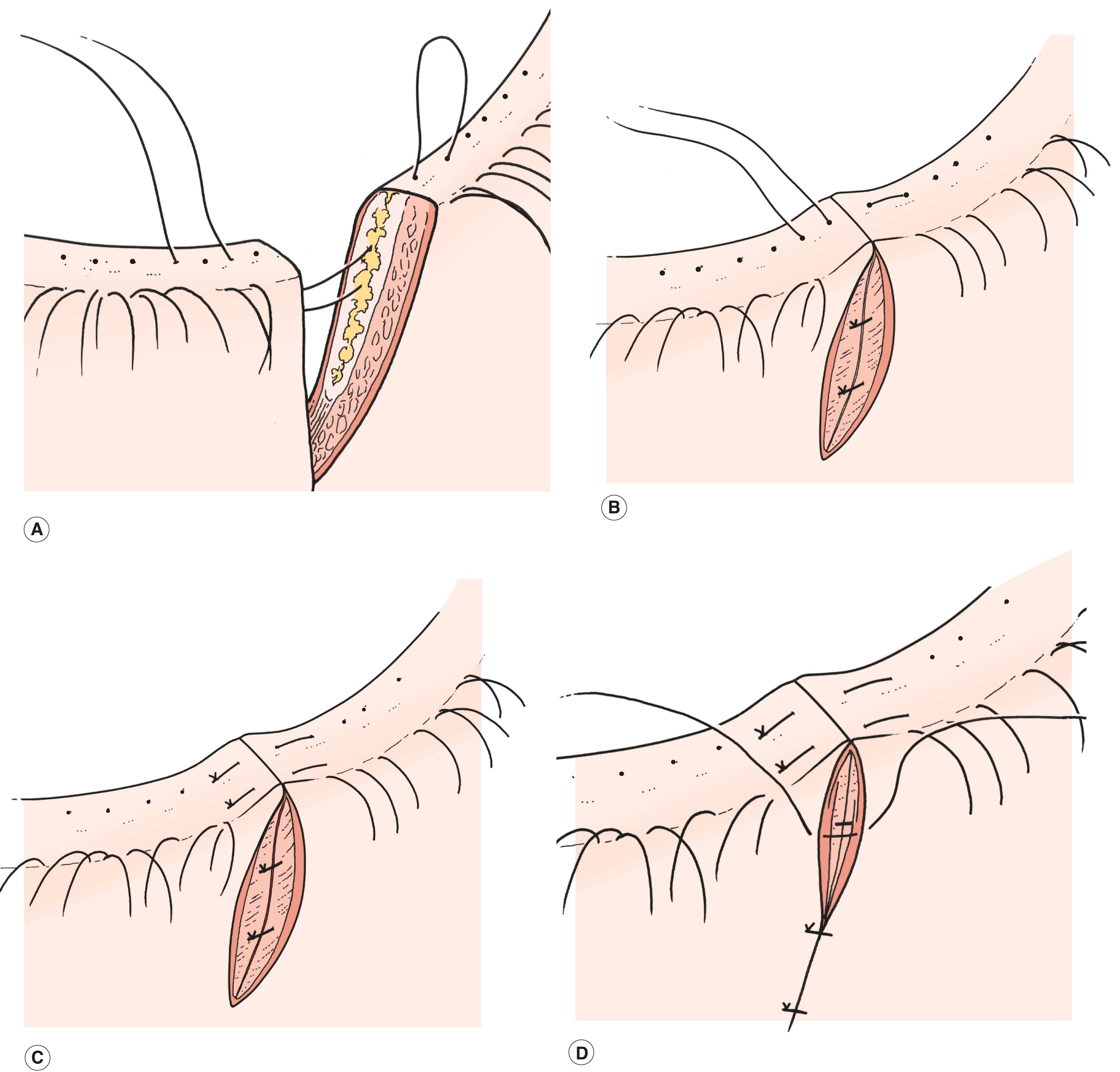 Figure 13.10, Lid margin repair. ( A ) Align the lid margin using a vertical mattress suture passed through the meibomian gland orifices. ( B ) Suture the tarsal plate using two or three interrupted sutures passed in a lamellar fashion. ( C ) Suture the lid margin using an additional vertical mattress suture anterior to the gray line. ( D ) Close the skin.