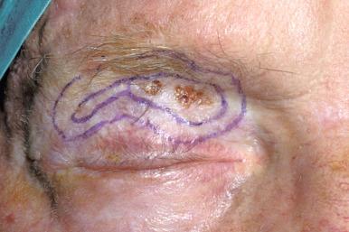 Fig. 15.4a, Basal cell carcinoma of upper lid. Excised with frozen section control.