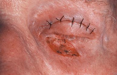 Fig. 15.1b, Lesion excised. A skin graft has been taken from the upper lid.