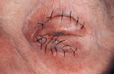 Fig. 15.1c, Upper lid skin graft sutured into the defect.