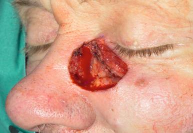 Fig 15.3a, Large medial canthal and upper cheek defect following tumour excision.