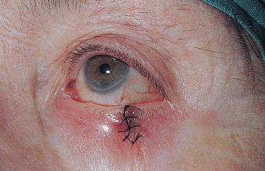 Fig. 14.1f, Eyelid closed. Ends of the lid margin suture beneath the skin sutures.