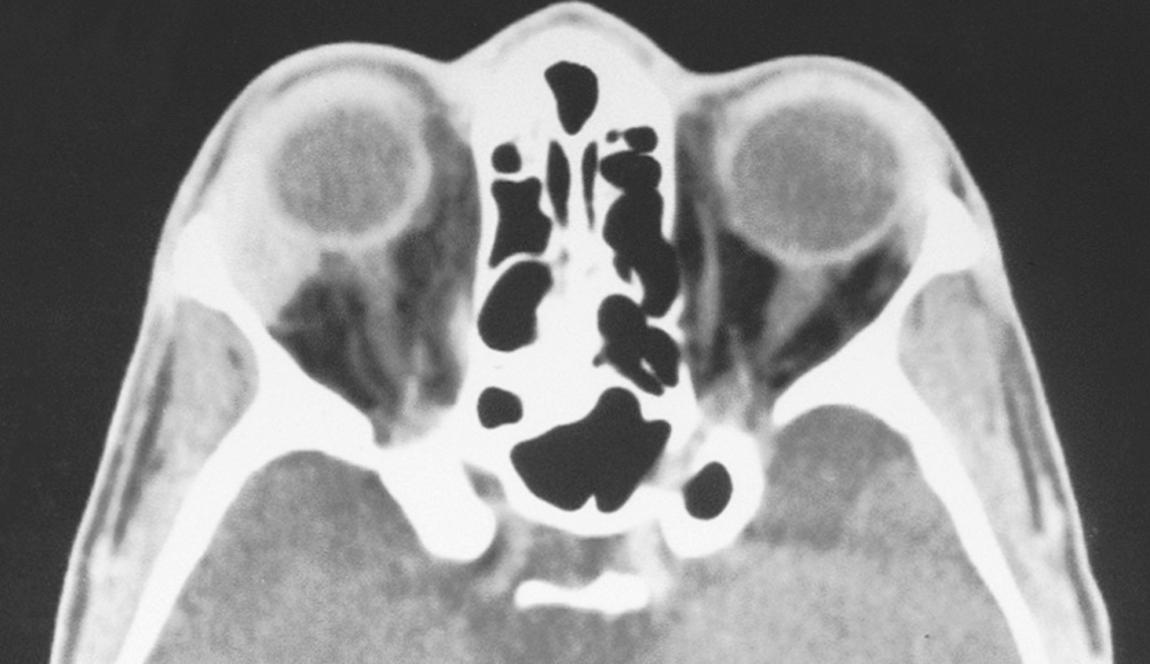 Figure 4.15, Contrast-enhanced computed tomography scan of a patient with a right-sided orbital pseudotumor.