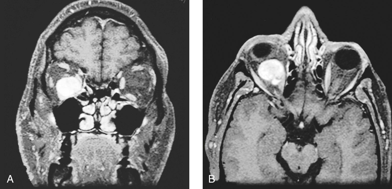 Figure 4.17, Magnetic resonance imaging scan of a patient with a liposarcoma of the right orbit. A , Coronal view. B , Axial view.