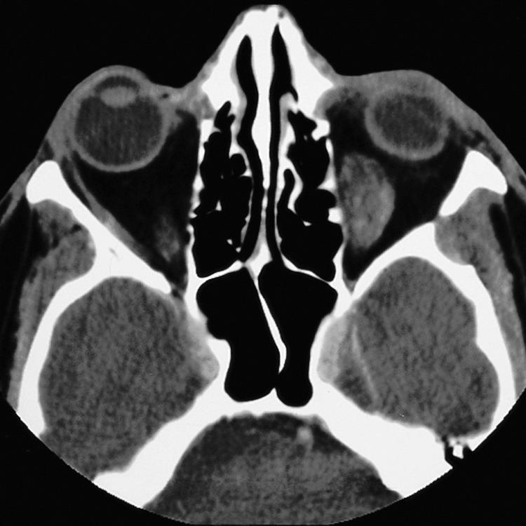 Figure 4.18, Computed tomography scan of a patient with a leiomyosarcoma of the left orbit.