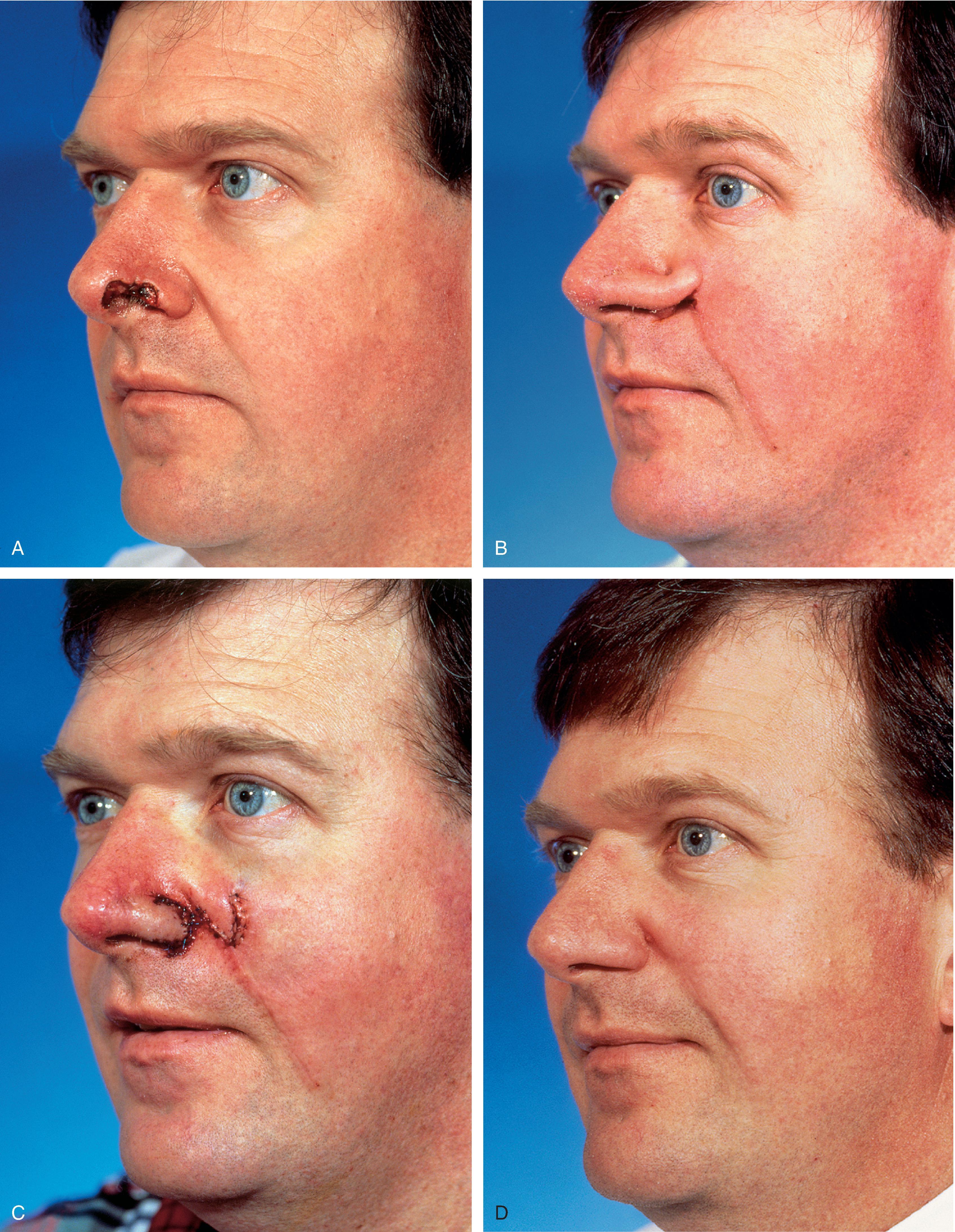 FIG. 6.17, A , 2 x .6 cm skin defect of alar rim after micrographic surgery for skin cancer. Internal lining provided by bipedicle vestibular skin advancement flap. Donor site of bipedicle flap closed with thin full thickness skin graft. Structural support provided by auricular cartilage rim graft. B , Cutaneous pedicle interpolated cheek flap secured over auricular cartilage graft positioned along nostril margin. C , One week after second stage division of pedicle and flap inset. D , Six months later. Critical alar facial sulcus preserved. No revision surgery performed. (From Fader DJ, Baker SR, Johnson TM: The staged cheek to nose interpolated flap for reconstruction of the nasal alar rim/lobule, J Am Acad Dermatol. 37:614, Fig. 4, p 618, 1997, with permission.)