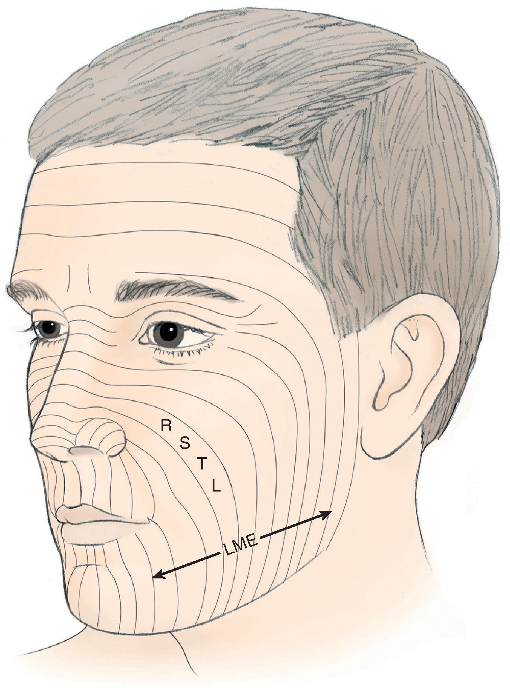 FIG. 6.3, Relaxed skin tension lines (RSTLs) of face. Lines of maximal extensibility (LME) are perpendicular to relaxed skin tension lines.