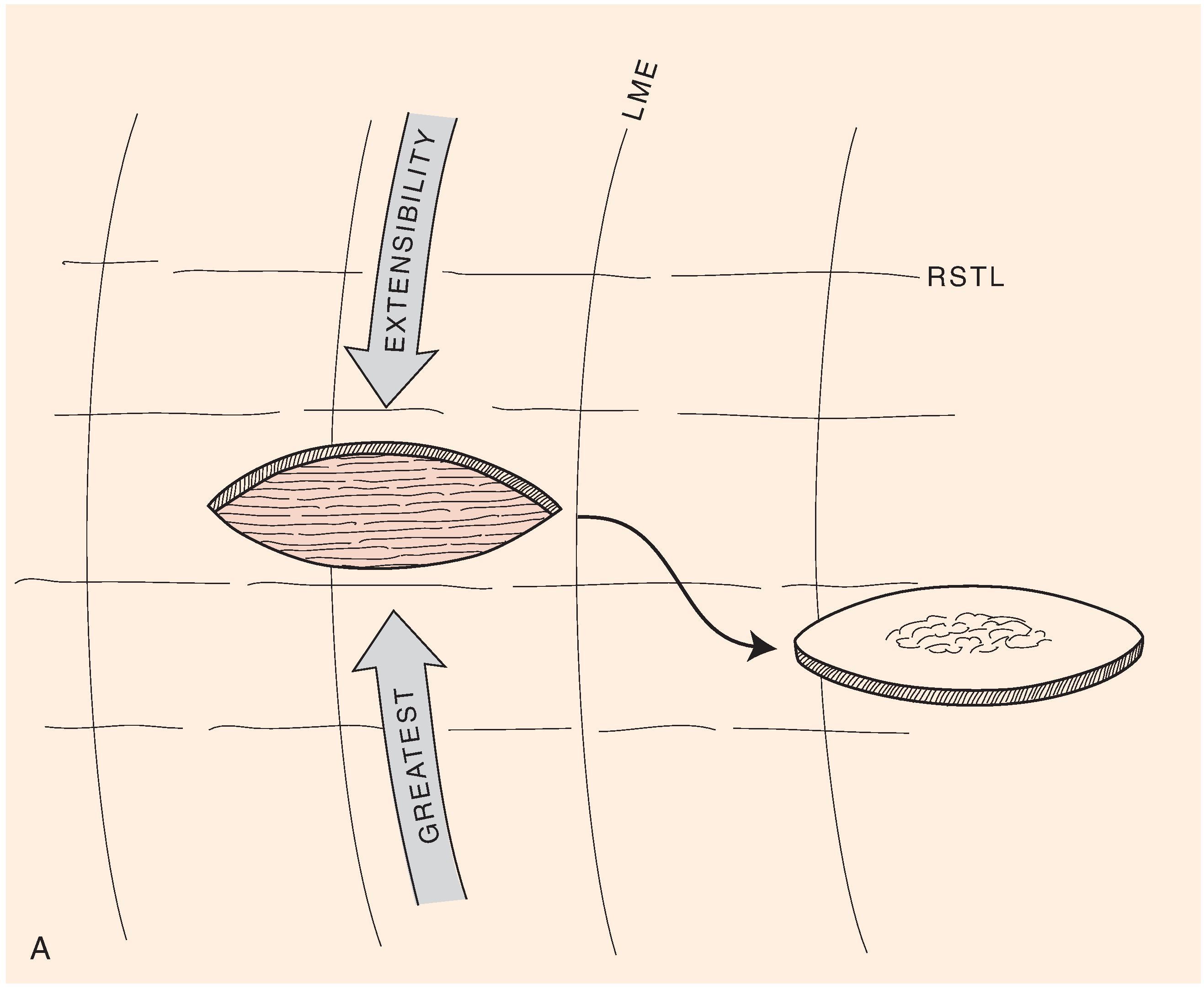 FIG. 6.4, A , B , Orientation of skin excisions and repair of wounds made parallel to relaxed skin tension lines (RSTL) when possible.