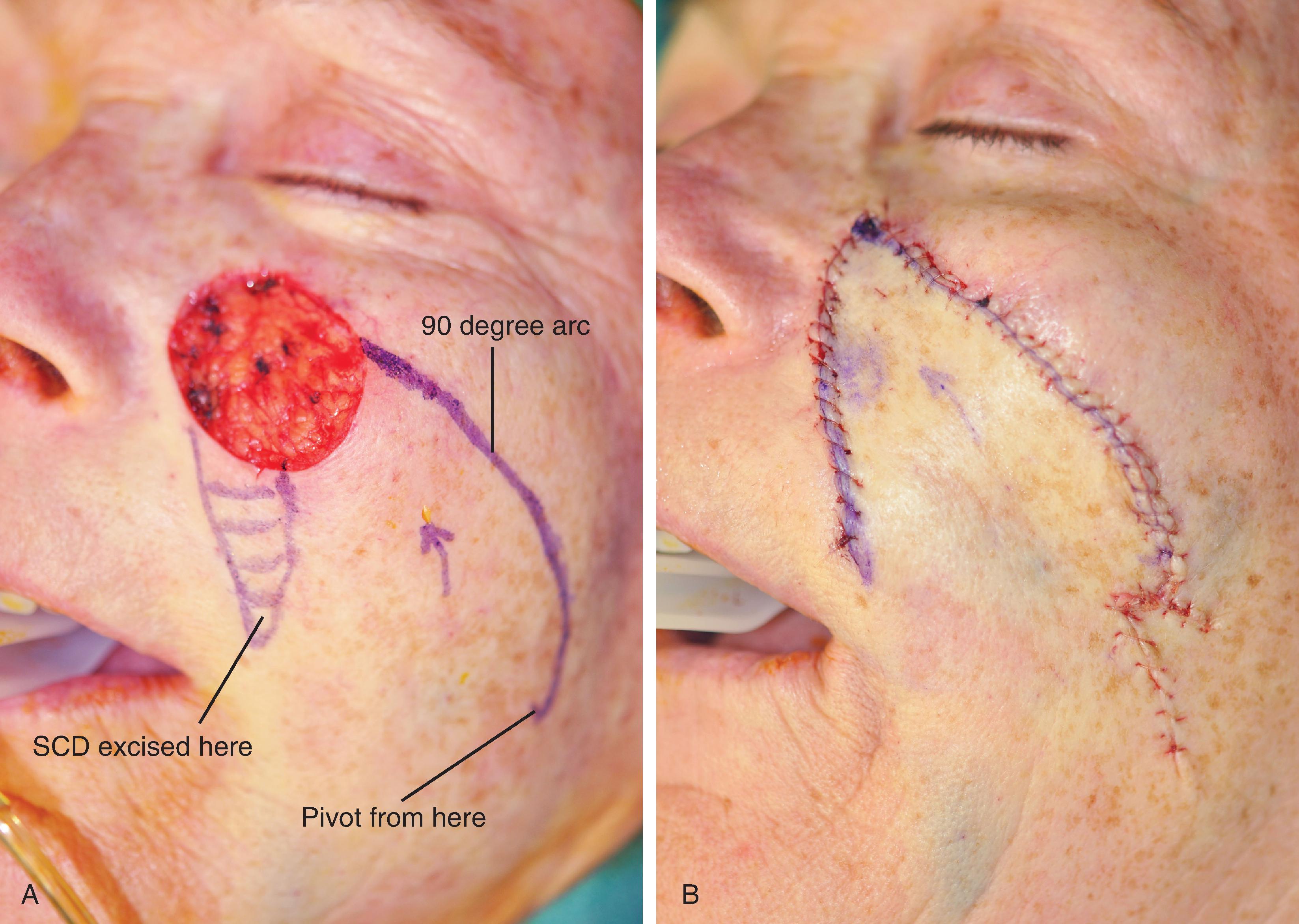 FIG. 6.10, A , 3 x 2.5 cm cutaneous defect of medial cheek. Rotation flap with 90° arc designed for repair. Standing cutaneous deformity (SCD) marked with horizontal lines. B , Flap in place. SCD excised. C , D , Postoperative results at 1 year. Scar revised at 6 months.