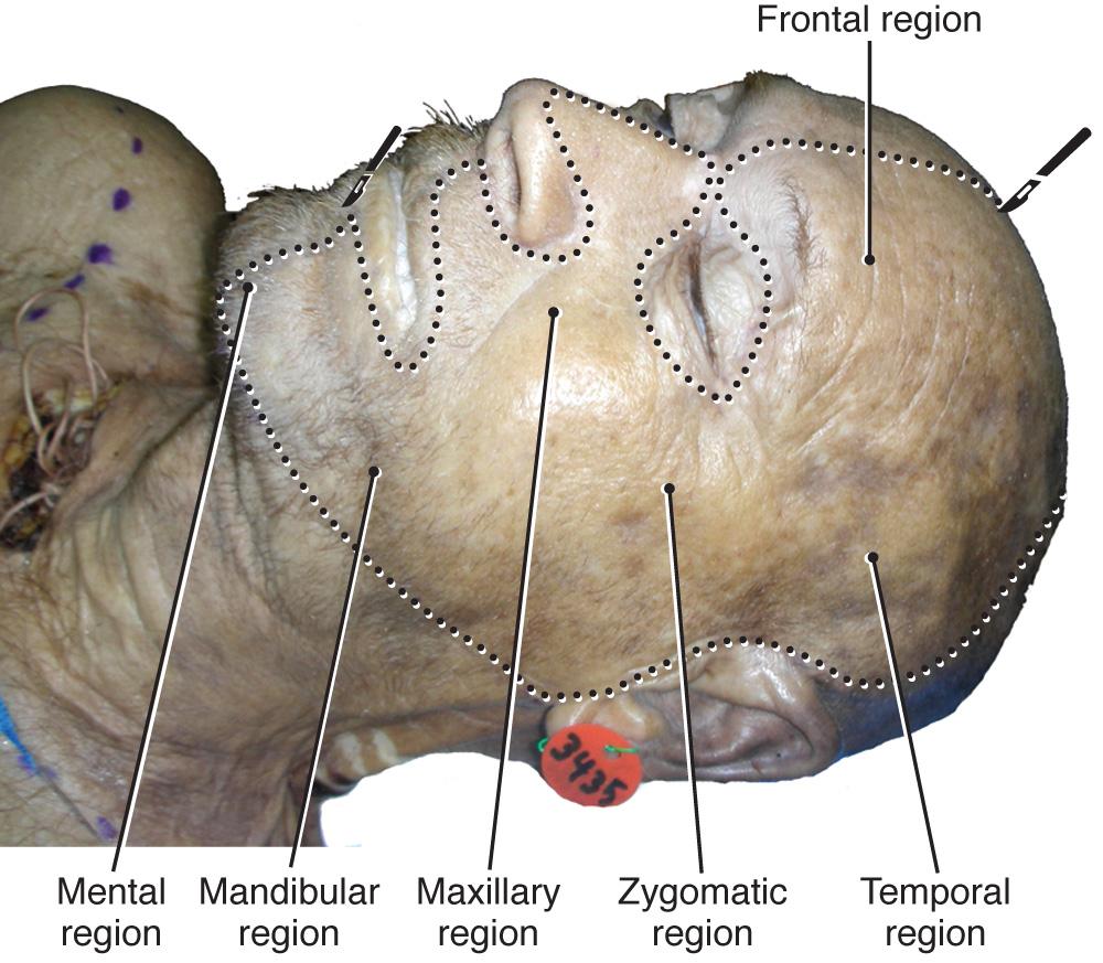 Fig. 21.1, Anterolateral facial view with stippled lines for incisions, showing the six major surface regions.