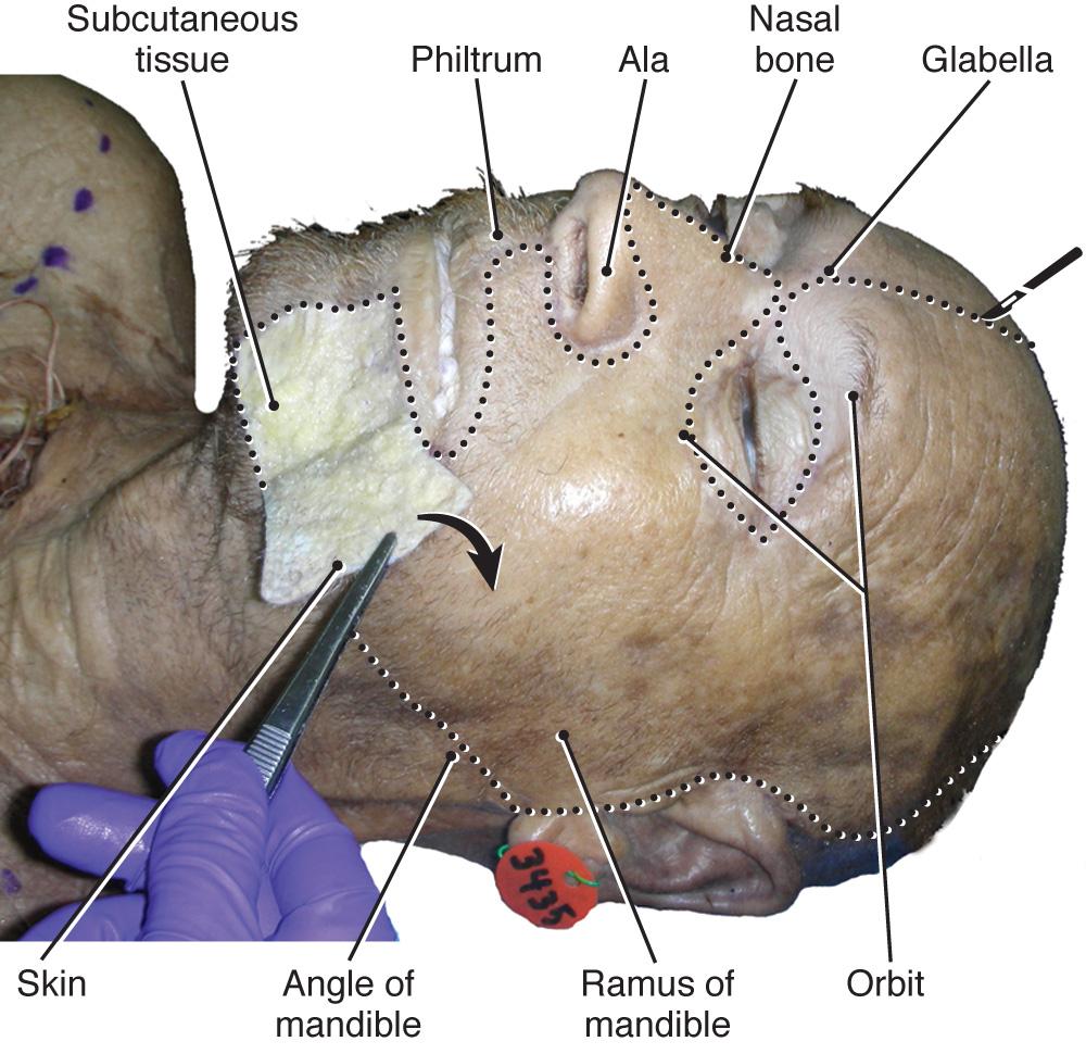 Fig. 21.2, Anterolateral facial view with skin reflected from the mental region and facial landmarks.