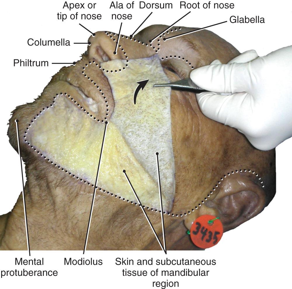 Fig. 21.3, Anterolateral facial view with skin reflected from the mandibular region.