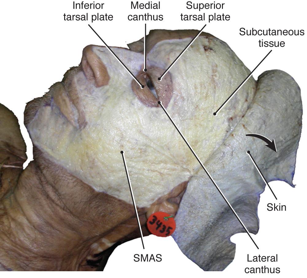 Fig. 21.4, Lateral facial view with skin reflected from mandibular, maxillary, zygomatic, frontal, and temporal regions.