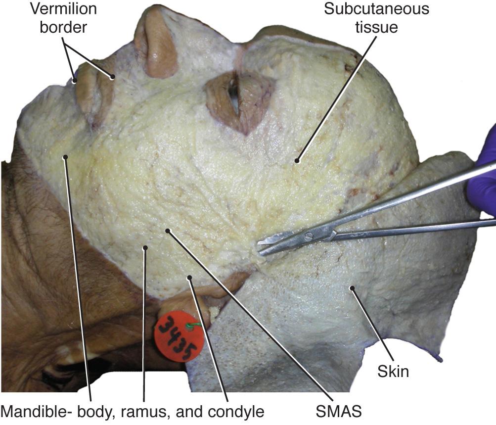 Fig. 21.5, Lateral facial view with skin reflected from mandibular, maxillary, zygomatic, frontal, and temporal regions.