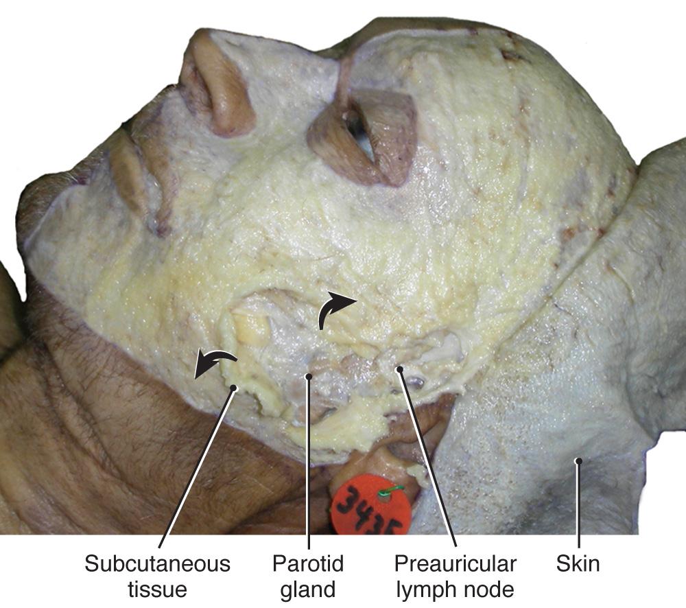 Fig. 21.6, Lateral facial view with skin reflected and SMAS removed from the mandibular region.