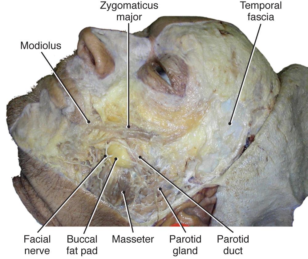 Fig. 21.8, Lateral facial view with skin reflected and SMAS removed from mandibular, maxillary, and temporal regions.