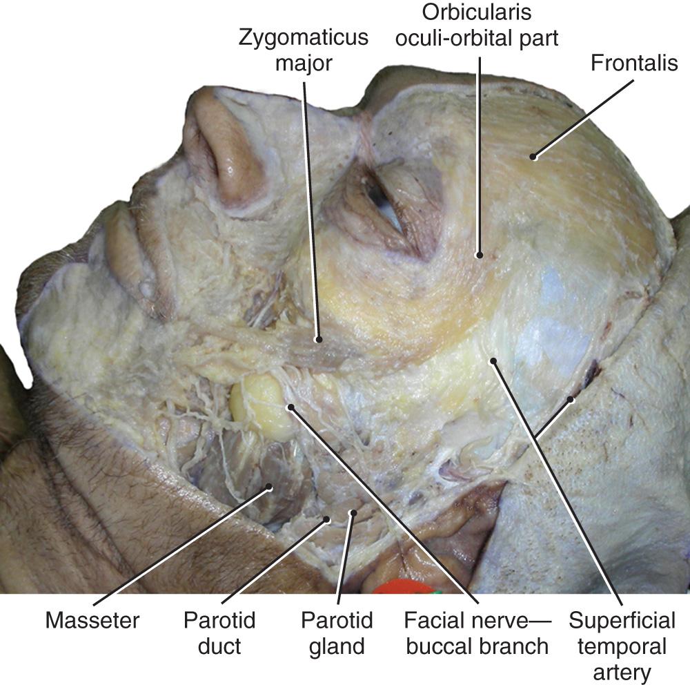 Fig. 21.9, Lateral facial view with skin reflected and subcutaneous tissue removed from the mandibular, maxillary, and orbital regions.